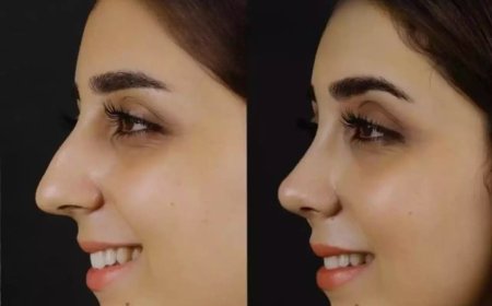 Experience Matters: Meet the Best Septoplasty Surgeon in Dubai