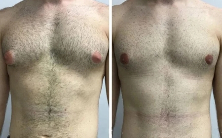 The Role of Technology in Procedures by the Best Gynecomastia Surgeon in Dubai
