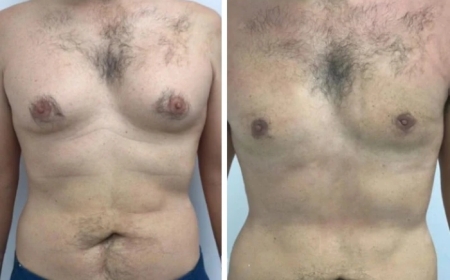 What to Expect from Your First Consultation with the Best Gynecomastia Surgeons in Dubai