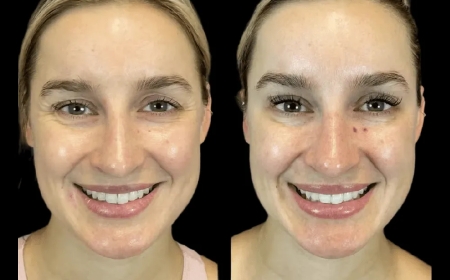 Botox Treatment in Dubai for Men: The New Face of Male Grooming