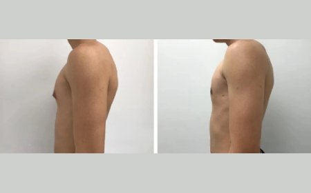 Trust the Best Doctors in Dubai for Your Gynecomastia Surgery and Recovery