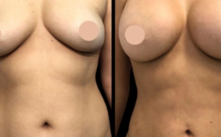 Choosing the Best Breast Augmentation Surgeon in Dubai: A Smart Guide