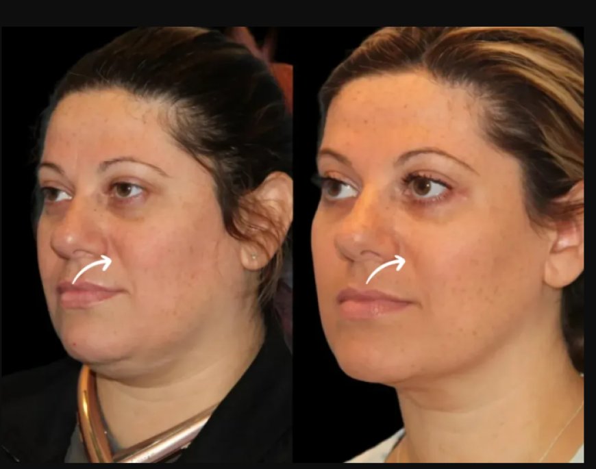 Why Models and Influencers Trust the Best Plastic Surgeons in Dubai for Sculptra Fillers Treatments