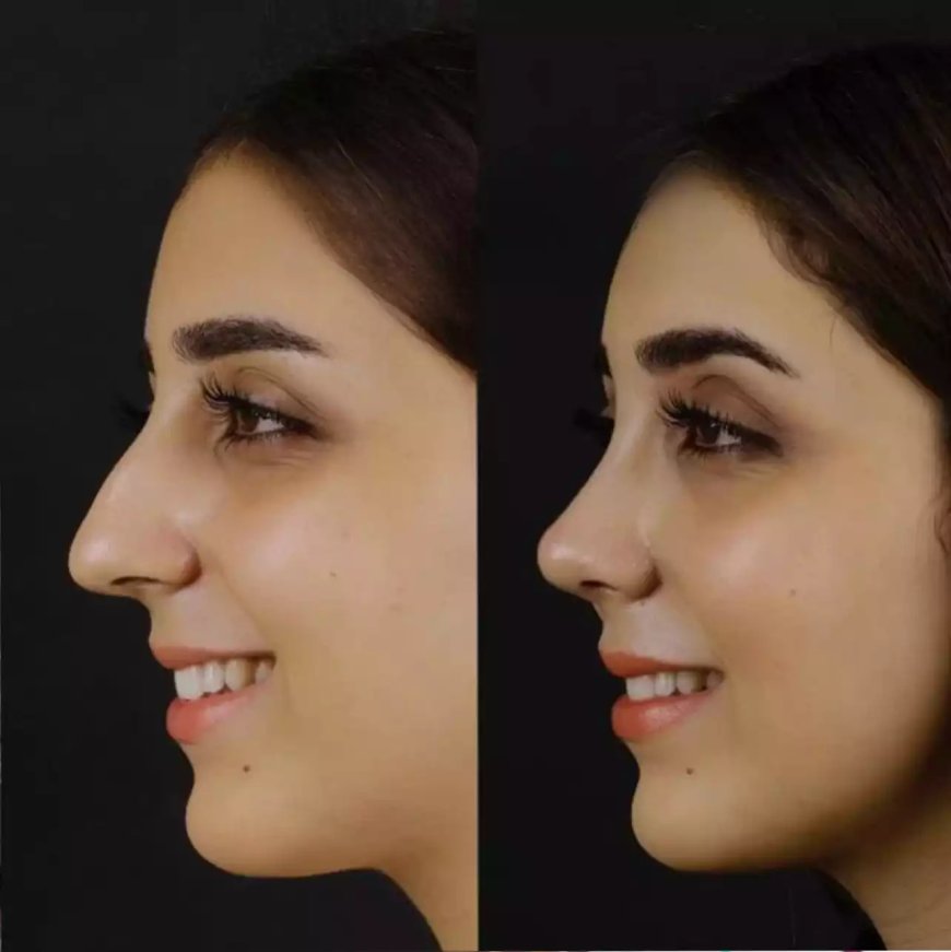 Experience Matters: Meet the Best Septoplasty Surgeon in Dubai