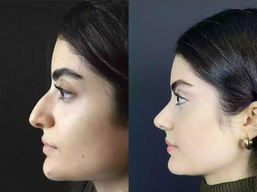 From Vision to Reality: The Best Rhinoplasty Surgeon in Dubai Delivers