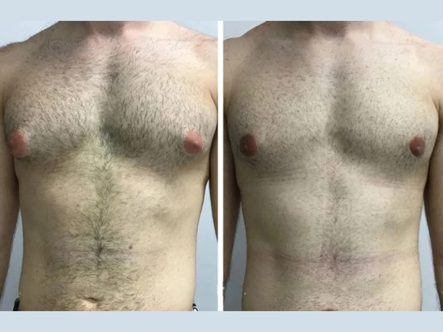 The Role of Technology in Procedures by the Best Gynecomastia Surgeon in Dubai