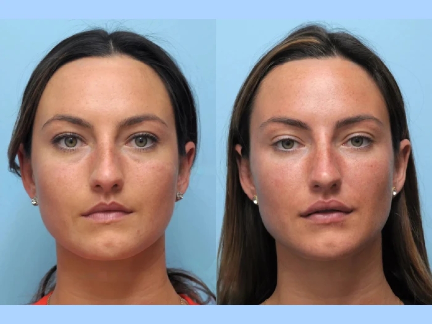 Best Plastic Surgeon in Dubai for Thread Lift Tailored to You