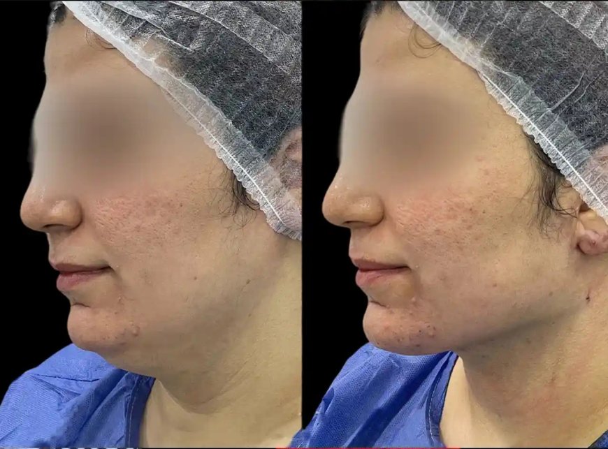 Best Plastic Surgeon in dubai for Chin Fillers: Expert Tips and Advice