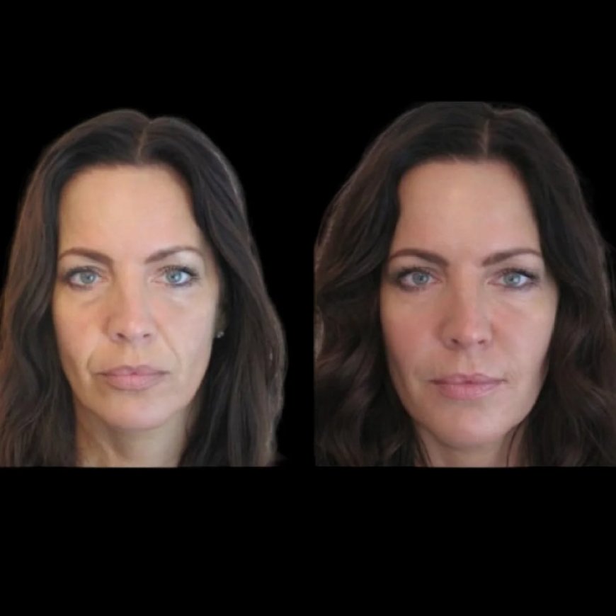 Best Plastic Surgeon in dubai for Jawline Fillers: How to Find the Best Clinic for Your Treatment