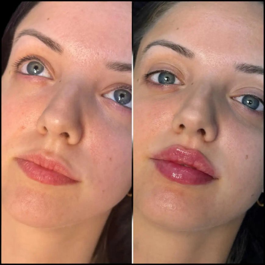 How to Maintain Fillers Results with the Best Plastic Surgeon in Dubai