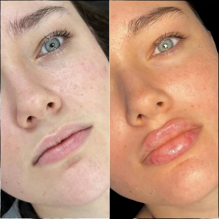 The Rise of Non-Surgical Fillers Treatment in Dubai