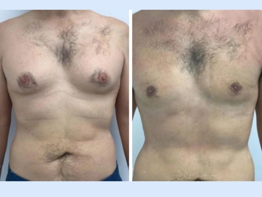 What to Expect from Your First Consultation with the Best Gynecomastia Surgeons in Dubai