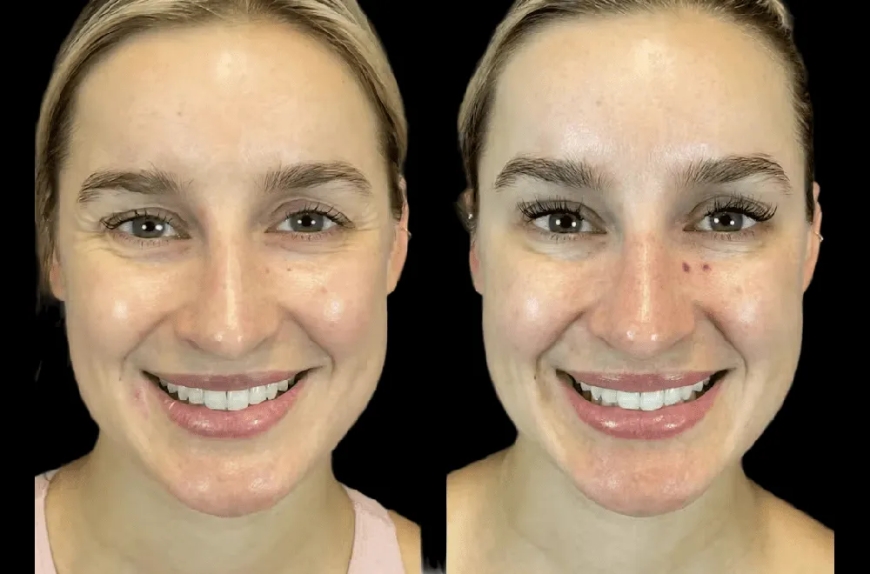 Botox Treatment in Dubai for Men: The New Face of Male Grooming