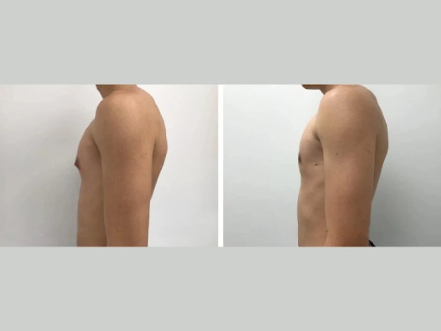 Can Diet Help Reduce Gynecomastia? Nutrition Tips from Dubai Experts