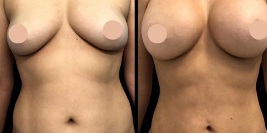 Your Best Self Starts with Breast Augmentation in Dubai