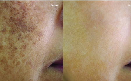 Pigmentation Removal in Bangalore: Simple Solutions for Clearer Skin