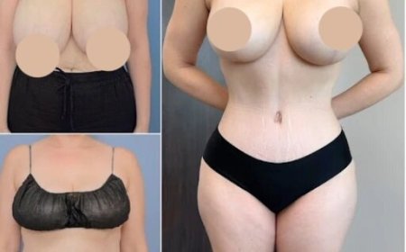 Top Tips for Finding the Best Tummy Tuck Surgeon in Dubai