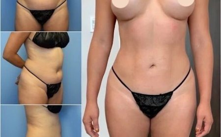 Best Body Contouring Surgeon in Dubai: Aesthetic Excellence for the Perfect Body