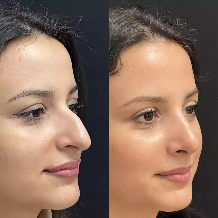 Best Surgeons for Nose Deviated Septum Surgery in Dubai
