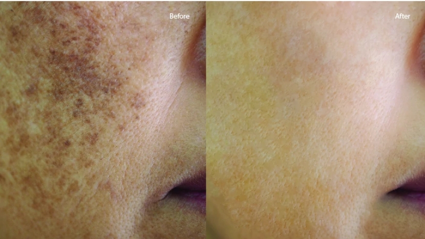 Pigmentation Removal in Bangalore: Simple Solutions for Clearer Skin