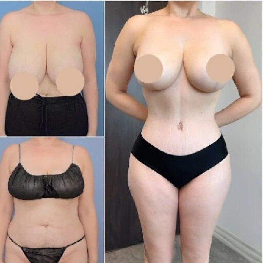 Top Tips for Finding the Best Tummy Tuck Surgeon in Dubai