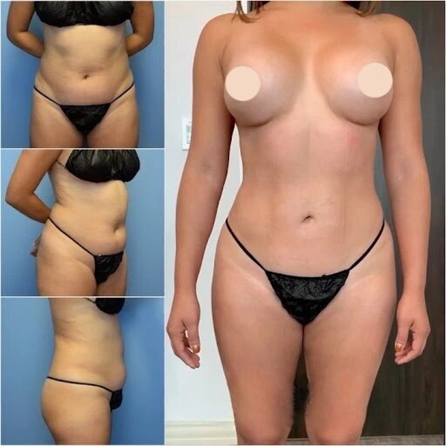 Best Body Contouring Surgeon in Dubai: Aesthetic Excellence for the Perfect Body
