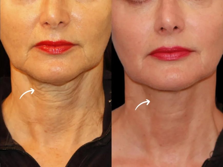 Eco-Friendly Practices in Sculptra Fillers Use at Dubai’s Best Aesthetic Clinic