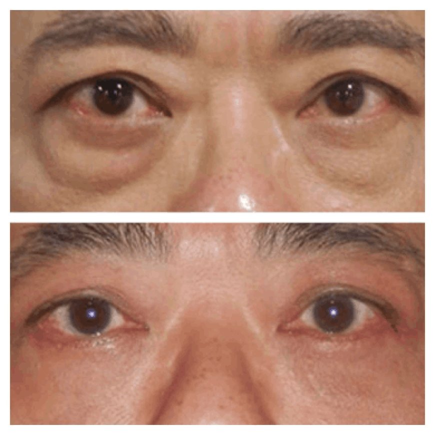 What to expect before and after Eye bag removal in Dubai