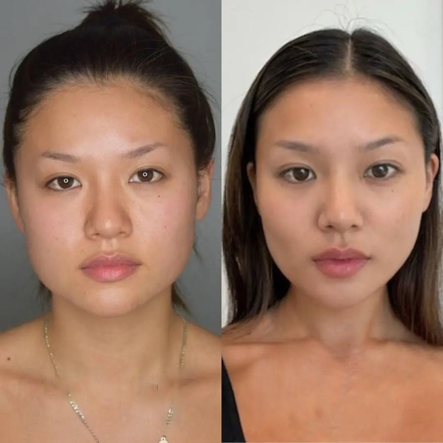 Buccal Fat Removal in Dubai: A Boost for Career Confidence?