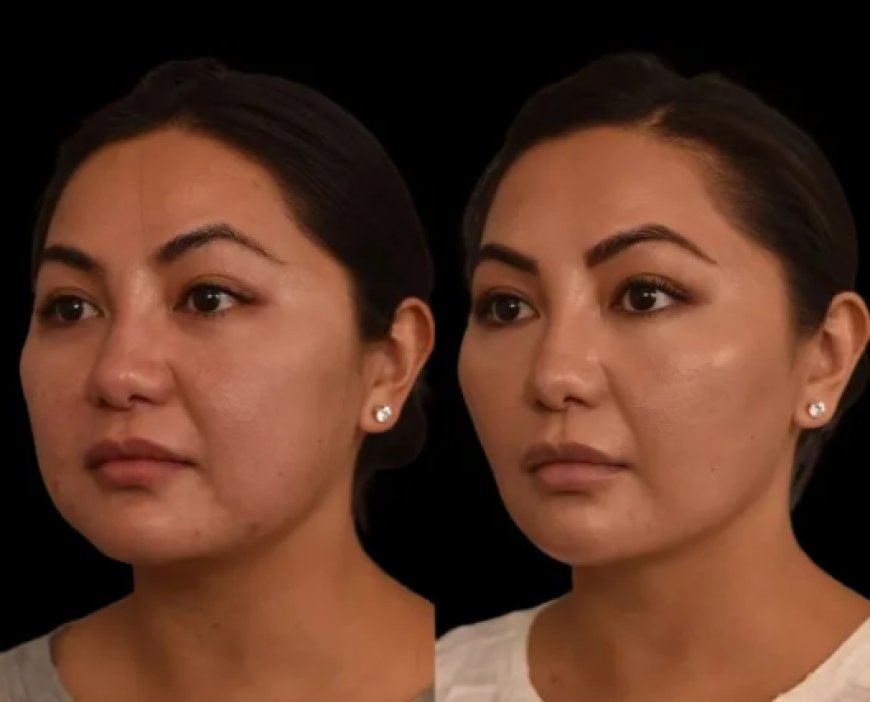 Seasonal Tips: Best Time to Get Double chin removal in Dubai